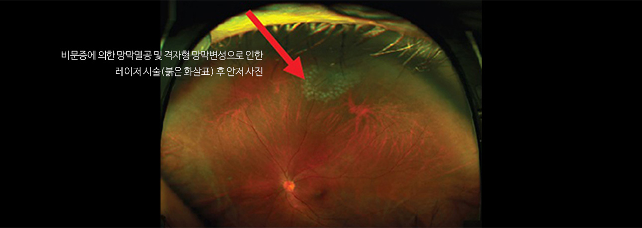 비문증에 의한 망막열공 및 격자형 망막변성으로 인한 레이저 시술(붉은 화살표) 후 안저 사진