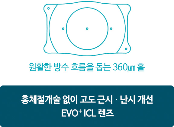 원활한 방수 흐름을 돕는 360㎛ 홀. 홍체절개술 없이 고도 근시 · 난시 개선 EVO⁺ ICL 렌즈