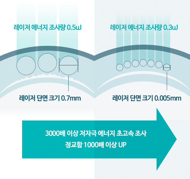 일반 라식 엑시머 레이저 대비 스마일수술 펨토초 레이저가 3000배 이상 저자극 초고속 에너지 조사, 1000배 이상 정교함 UP