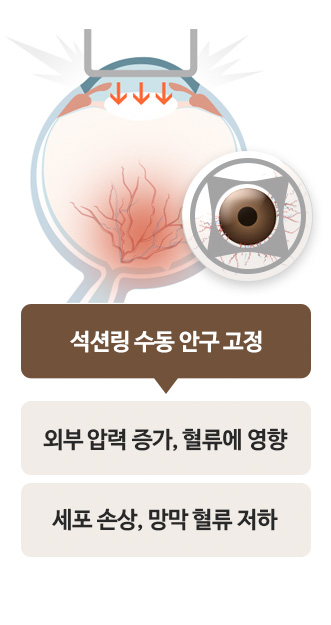 외부 압력 ↑ 혈류에 영향 O / 세포 손상, 건조증 악화, 망막혈류저화, 시야 상실