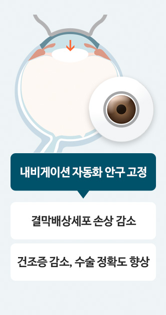 외부 압력 ↓ 혈류에 영향 X / 결막하출혈 없음, 수술 정확도 향상