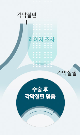 수술 후 각막절편 덮음