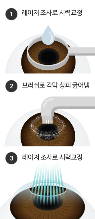 1.레이저 조사로 시력교정 / 2.브러쉬로 각막 상피 긁어냄 / 3.레이저 조사로 시력교정