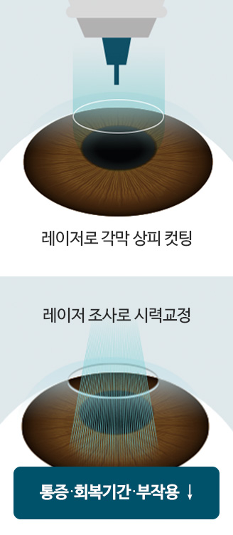 레이저로 각막 상피 컷팅 동시 레이저 조사로 시력교정. 통증 | 회복기간 | 부작용 ↓