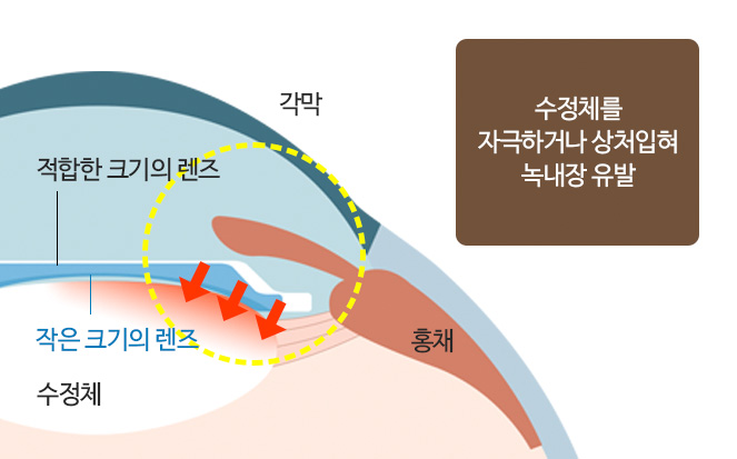 수정체를 자극하거나 상처 입혀 녹내장 유발