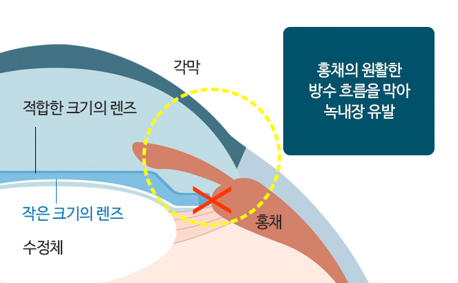 홍채의 원활한 방수의 흐름을 막아 녹내장 유발