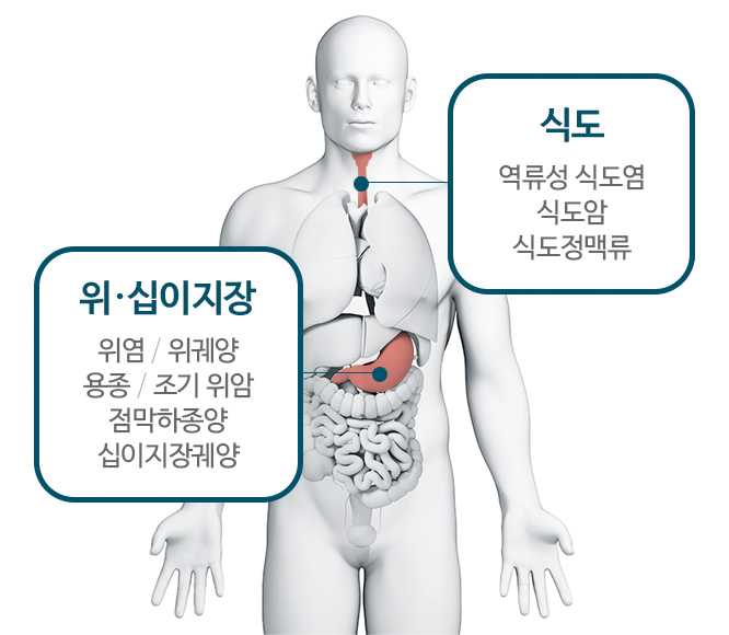 식도 : 역류성 식도염, 식도암, 식도정맥류 / 위·십이지장 : 위염, 위궤양, 용종 조기 위암, 점막하종양, 십이지장궤양