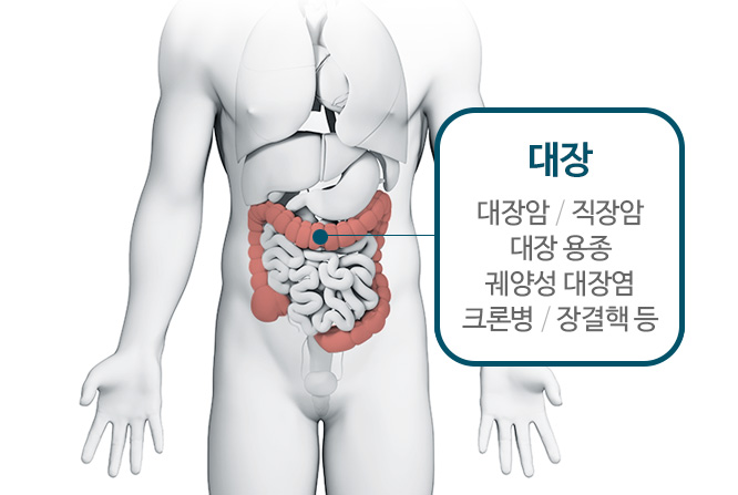 대장 : 대장암, 직장암, 대장 용종, 궤양성 대장염, 크론병, 장결핵 등